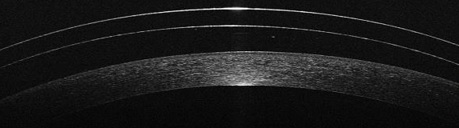 Lente escleral apoyada en la córnea. Imagen tomada con OCT-SA