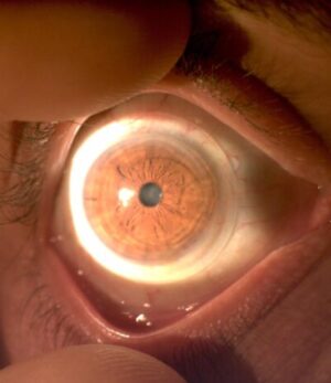 Lentes escleral en cicatriz corneal